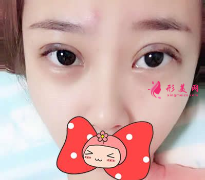 找武漢協(xié)和郭能強(qiáng)做的雙眼皮 術(shù)后60天效果真的超乎我的想象