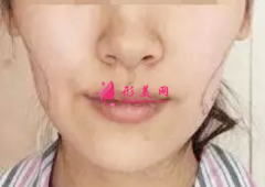 自體脂肪填充臉部要多久恢復(fù)自然？