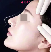 假體隆鼻哪里做得比較好？
