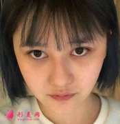 北京八大處靳小雷雙眼皮效果怎么樣？專家案例展示實(shí)力！