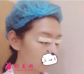 南京連天美吳應凱做雙眼皮怎么樣？90天前后對比圖案例分享