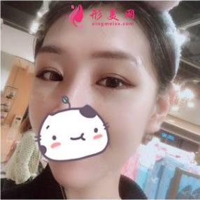 南京連天美吳應凱做雙眼皮怎么樣？90天前后對比圖案例分享
