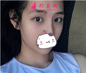 南京連天美吳應凱做雙眼皮怎么樣？90天前后對比圖案例分享