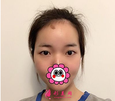 杭州藝星整形樸正馨做雙眼皮手術(shù)怎么樣？60天前后對(duì)比圖案例分享