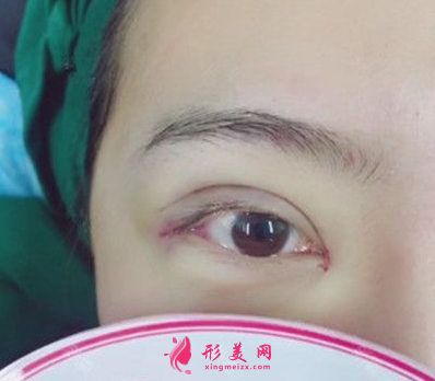 杭州藝星整形樸正馨做雙眼皮手術(shù)怎么樣？60天前后對(duì)比圖案例分享