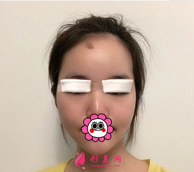 杭州藝星整形樸正馨做雙眼皮手術(shù)怎么樣？60天前后對(duì)比圖案例分享