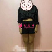 在上海第九人民醫(yī)院整形科做了大腿吸脂，輕松擺脫大象腿