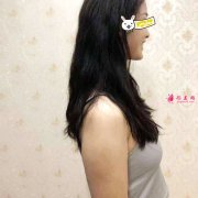 南京美立方整形醫(yī)院手臂吸脂案例，吊帶美美的穿起來
