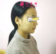 南京伊美尚整形醫(yī)院假體隆下巴案例分享，讓我更加自信美麗