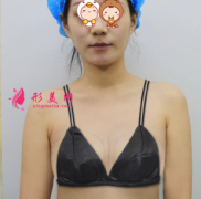上海美侖整形醫(yī)院假體隆胸案例，我也能擁有性感大酥胸啦