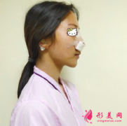 天津美萊整形醫(yī)院肋軟骨隆鼻太自然了，360度無死角