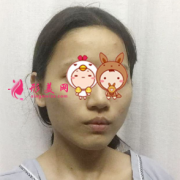 上海名仁整形醫(yī)院下頜角磨骨效果好自然，秒變小仙女
