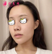 重慶美伽整形醫(yī)院磨骨案例分享，輕松瘦成小V臉