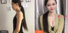 北京大學(xué)深圳醫(yī)院整形外科隆胸效果怎么樣_案例分享