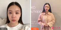 北大深圳醫(yī)院整形美容科瘦臉針多少錢？手術(shù)恢復(fù)效果圖
