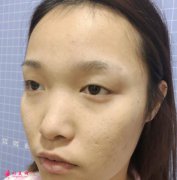 深圳北大醫(yī)院雙眼皮怎么樣？醫(yī)生案例一覽