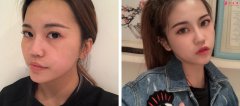 深圳京韓整形醫(yī)院怎么樣？脂肪填充面部太陽穴案例一覽