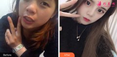 深圳美萊整形醫(yī)院隆鼻怎么樣？真實(shí)隆鼻案例效果你i了嗎？