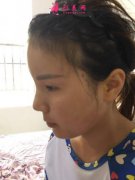 深圳鵬愛秀琪醫(yī)療脂肪填充案例圖，效果是你喜歡的款嗎？