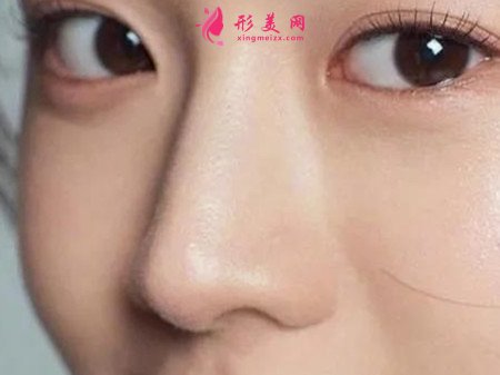 假體隆鼻后會(huì)不會(huì)變形