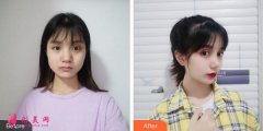 大連三院整形美容科隆鼻好不好？附隆鼻案例恢復(fù)效果