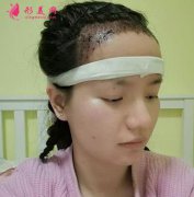 成都恒博種植發(fā)際線后，60天了恢復(fù)效果前后變化大