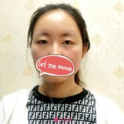南京亞韓整形醫(yī)院眼綜合整形案例 效果比我想的還要好