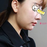 想變小V臉，就去北京純脂整形醫(yī)院-專注脂肪整形