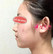 寧波韓美美容醫(yī)院假體隆下巴親身經(jīng)歷，分享美麗體驗