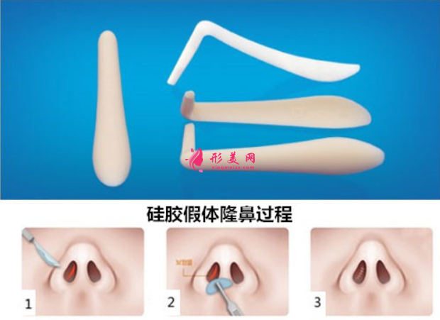 假體隆鼻會有副作用嗎