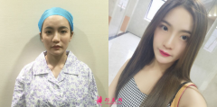 上海玫瑰醫(yī)療趙醫(yī)生諾斯仿生鼻60天恢復實例