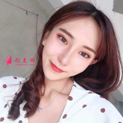 去上海華美找張明醫(yī)生做眼綜合手術(shù)后1個(gè)月
