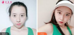 上海伯思立醫(yī)療美容面部脂肪填充案例