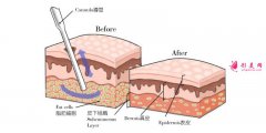 面部抽脂跟激光溶脂哪個(gè)效果好？