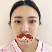 北京彤美醫(yī)療美容醫(yī)院歪鼻修復(fù)案例，歪鼻洗碗妹到精致美女的逆襲