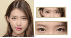 開(kāi)眼角多少度適合？?jī)r(jià)格有什么差別嗎？