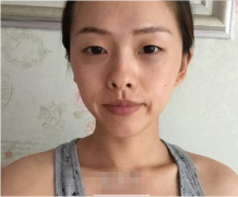 西南醫(yī)院割眼袋技術(shù)怎么樣？能改變我這憔悴面容嗎？