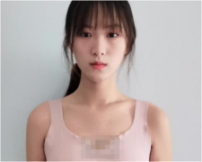 北京京美自體脂肪豐胸案例分享｜90天恢復(fù)效果圖展示~