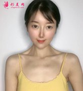 上海華美醫(yī)療美容整形假體隆胸術(shù)后兩個(gè)月恢復(fù)日記