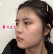 上海伯思立整形隆鼻后兩個(gè)月恢復(fù)效果分享
