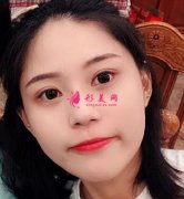 上海華美整形醫(yī)院雙眼皮手術怎么樣？30天后恢復效果好還想做鼻子