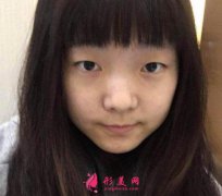 上海九院整形價格表_附雙眼皮案例前后對比圖一覽