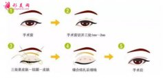 全切雙眼皮痛嗎？是局麻還是全麻？