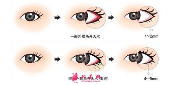 全切雙眼皮痛嗎？是局麻還是全麻？