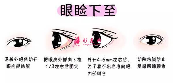 眼綜合手術(shù)有幾項(xiàng)