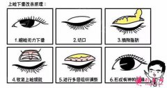 【醫(yī)美攻略】眼綜合手術(shù)有幾項(xiàng)？眼綜合價(jià)格