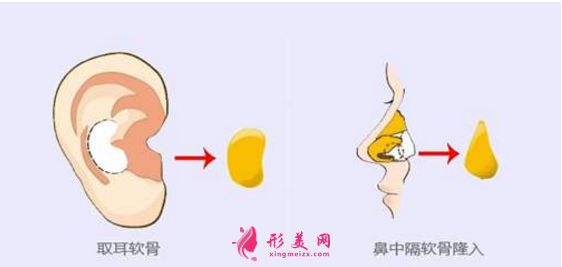 自體軟骨隆鼻尖價(jià)格