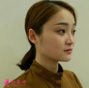 西安西美整形隆鼻手術(shù)后兩個(gè)月恢復(fù)效果分享_含醫(yī)生介紹一覽