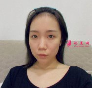 鄭州華領(lǐng)整形醫(yī)院雙眼皮案例效果分享_附真實恢復(fù)經(jīng)驗反饋