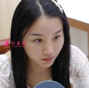 北京潤美玉之光醫(yī)療美容小仙女鼻綜合手術一年恢復對比圖